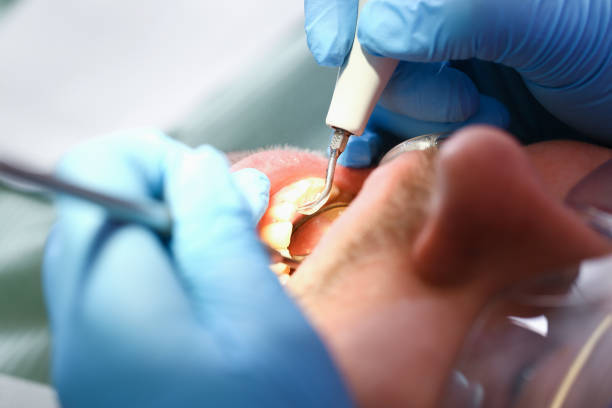Best Chipped Tooth Repair Near Me  in Boyce, LA
