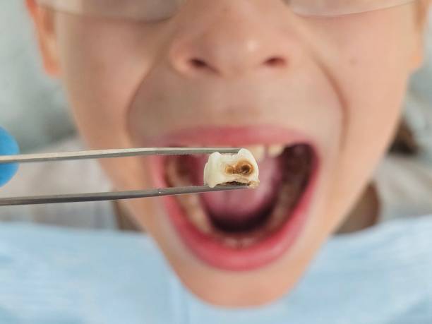 Best Knocked-Out Tooth Emergency  in Boyce, LA
